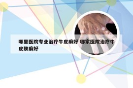 哪里医院专业治疗牛皮癣好 哪家医院治疗牛皮肤癣好