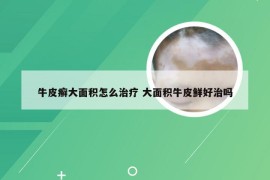 牛皮癣大面积怎么治疗 大面积牛皮鲜好治吗