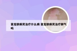 苗龙肤癣灵治疗什么病 苗龙肤癣灵治疗脚气吗