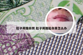 肚子周围白斑 肚子周围起白屑怎么办