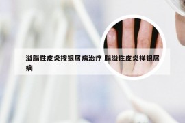 溢脂性皮炎按银屑病治疗 脂溢性皮炎样银屑病