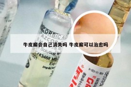 牛皮廨会自己消失吗 牛皮廨可以治愈吗