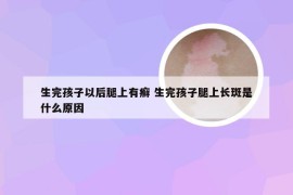 生完孩子以后腿上有癣 生完孩子腿上长斑是什么原因