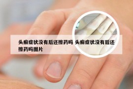 头癣症状没有后还擦药吗 头癣症状没有后还擦药吗图片