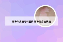 新乡牛皮癣专科医院 新乡治疗皮肤病