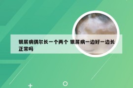 银屑病偶尔长一个两个 银屑病一边好一边长正常吗