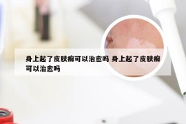 身上起了皮肤癣可以治愈吗 身上起了皮肤癣可以治愈吗