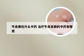 牛皮癣吃什么中药 治疗牛皮皮癣的中药有哪些