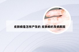 皮肤癣是怎样产生的 皮肤癣的发病原因