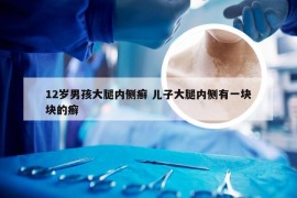 12岁男孩大腿内侧癣 儿子大腿内侧有一块块的癣