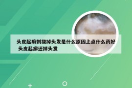 头皮起癣刺挠掉头发是什么原因上点什么药好 头皮起癣还掉头发