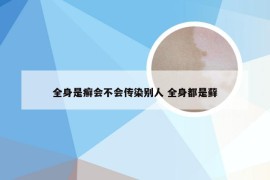 全身是癣会不会传染别人 全身都是藓