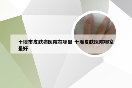 十堰市皮肤病医院在哪里 十堰皮肤医院哪家最好