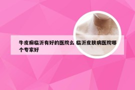 牛皮癣临沂有好的医院么 临沂皮肤病医院哪个专家好