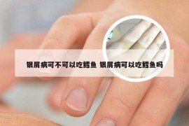 银屑病可不可以吃鳕鱼 银屑病可以吃鳕鱼吗