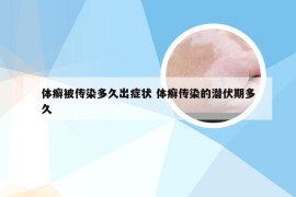 体癣被传染多久出症状 体癣传染的潜伏期多久