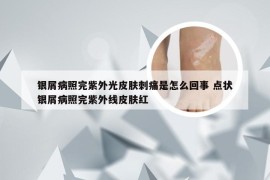 银屑病照完紫外光皮肤刺痛是怎么回事 点状银屑病照完紫外线皮肤红