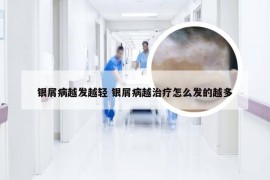 银屑病越发越轻 银屑病越治疗怎么发的越多