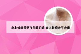 身上长癣是熬夜引起的嘛 身上长癣会不会痒