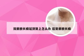 双肩膀长癣延到背上怎么办 后背肩膀长癣