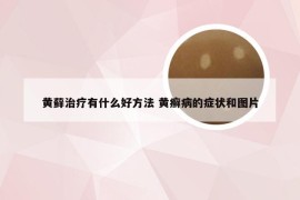 黄藓治疗有什么好方法 黄癣病的症状和图片