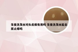 生姜洗发水对头皮癣有用吗 生姜洗发水能去屑止痒吗