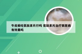 牛皮癣吃氨肽素片行吗 氨肽素片治疗银屑病有效果吗