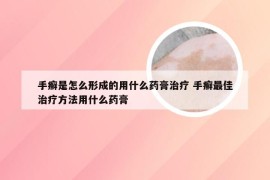 手癣是怎么形成的用什么药膏治疗 手癣最佳治疗方法用什么药膏