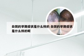 白斑的早期症状是什么样的 白斑的早期症状是什么样的呢