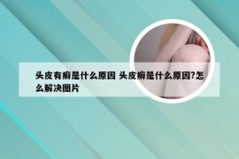 头皮有癣是什么原因 头皮癣是什么原因?怎么解决图片