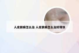 人皮肤癣怎么治 人皮肤癣怎么治好得快