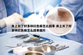 身上长了好多块红色癣怎么回事 身上长了好多块红色癣怎么回事图片