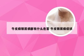 牛皮癣银屑病都有什么危害 牛皮银屑癣症状