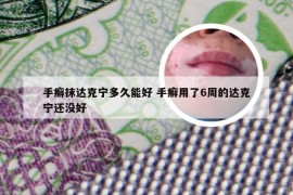 手癣抹达克宁多久能好 手癣用了6周的达克宁还没好