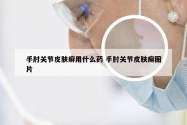 手肘关节皮肤癣用什么药 手肘关节皮肤癣图片