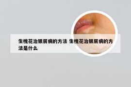 生槐花治银屑病的方法 生槐花治银屑病的方法是什么