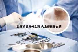 头部癣类用什么药 头上癣用什么药