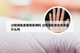 过敏源能查看银屑病吗 过敏源能查出具体是什么吗