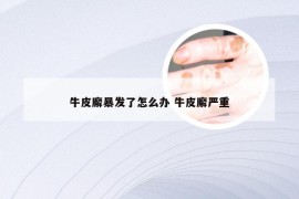 牛皮廨暴发了怎么办 牛皮廨严重