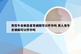 男性牛皮癣患者发病期可以怀孕吗 男人有牛皮病癣可以怀孕吗