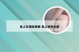 身上长满皮肤癣 身上到处长癣