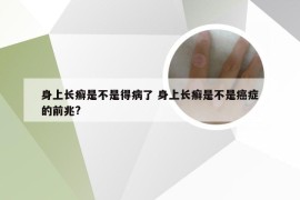 身上长癣是不是得病了 身上长癣是不是癌症的前兆?