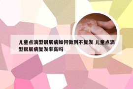 儿童点滴型银屑病如何做到不复发 儿童点滴型银屑病复发率高吗