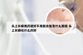 头上长癣用药就好不用就会复发什么原因 头上长癣吃什么药好