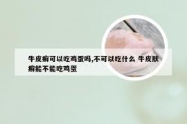 牛皮癣可以吃鸡蛋吗,不可以吃什么 牛皮肤癣能不能吃鸡蛋