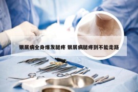 银屑病全身爆发腿疼 银屑病腿疼到不能走路