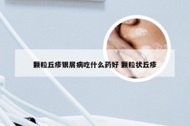 颗粒丘疹银屑病吃什么药好 颗粒状丘疹