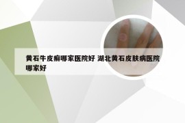 黄石牛皮癣哪家医院好 湖北黄石皮肤病医院哪家好