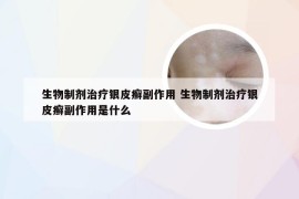 生物制剂治疗银皮癣副作用 生物制剂治疗银皮癣副作用是什么