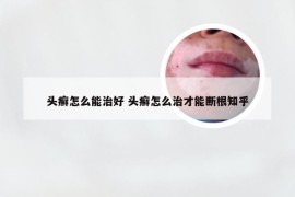 头癣怎么能治好 头癣怎么治才能断根知乎